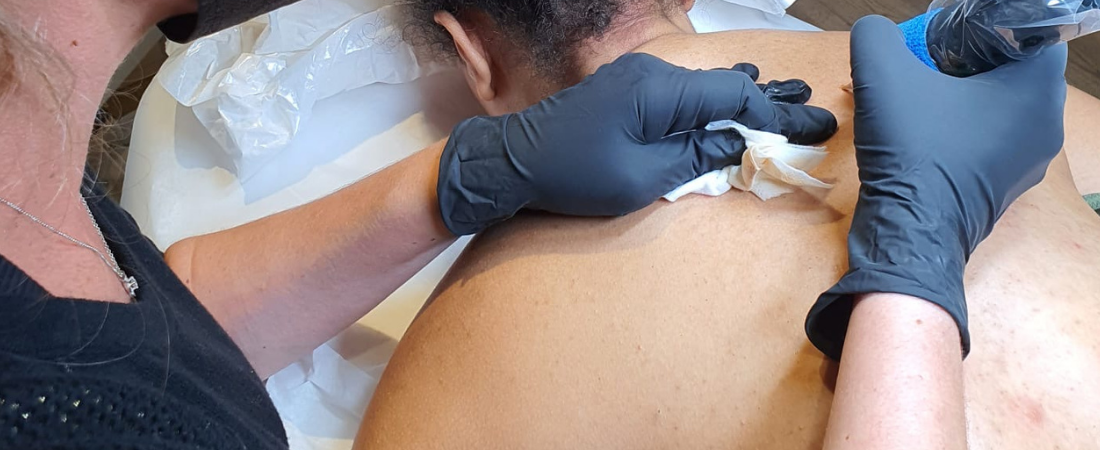 taches-cutanées-dermopigmentation