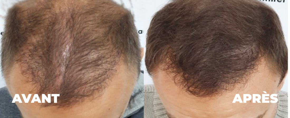 tricopigmentation-homme-reims