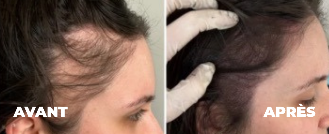 tricopigmentation-femme-reims