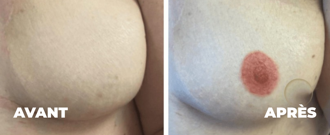 aerole-mammaire-dermopigmentation