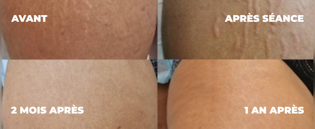 vergetures-dermopigmentation