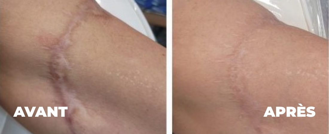 cicatrices-dermopigmentation